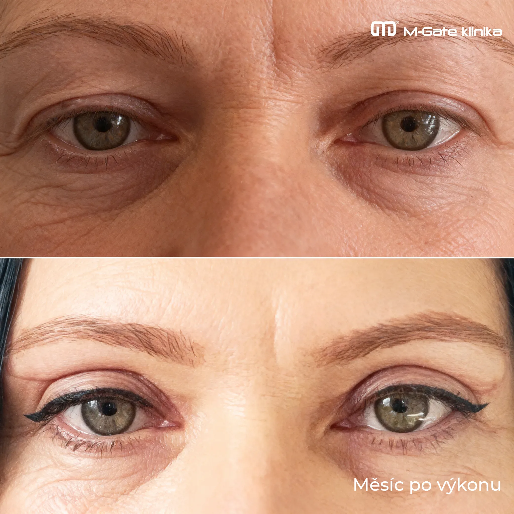 Operace víček - 11