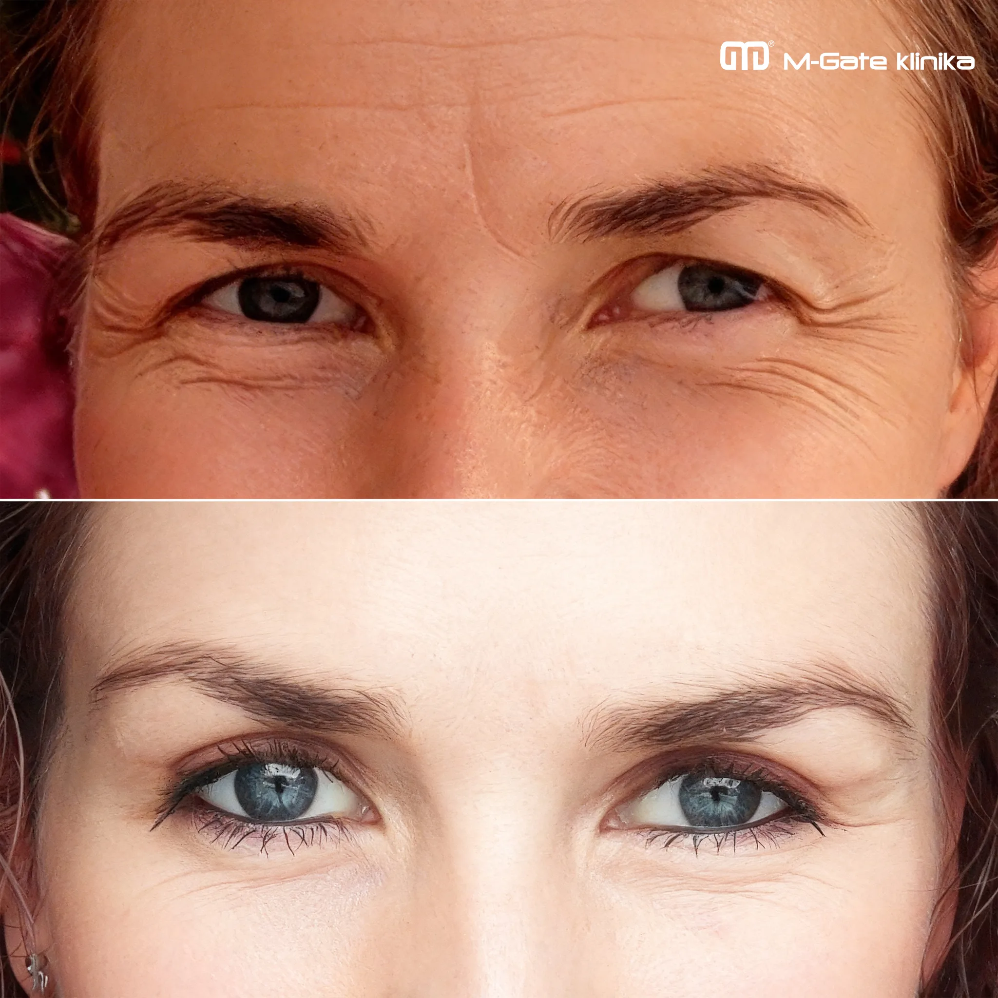 Operace víček - 14