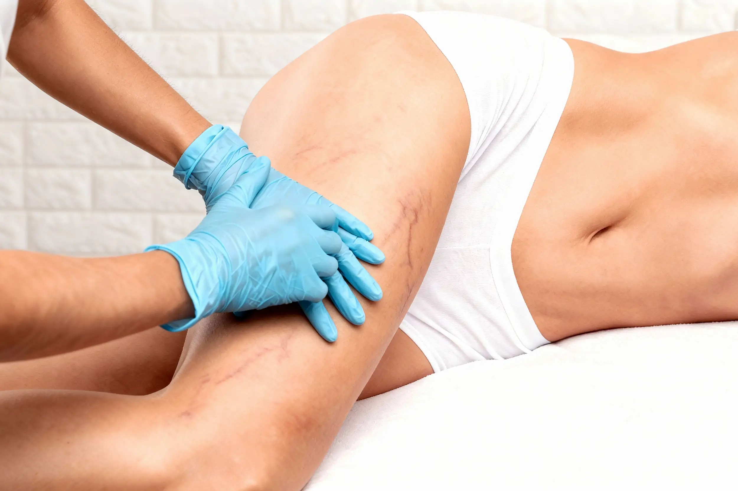 Křečové žíly M-gate